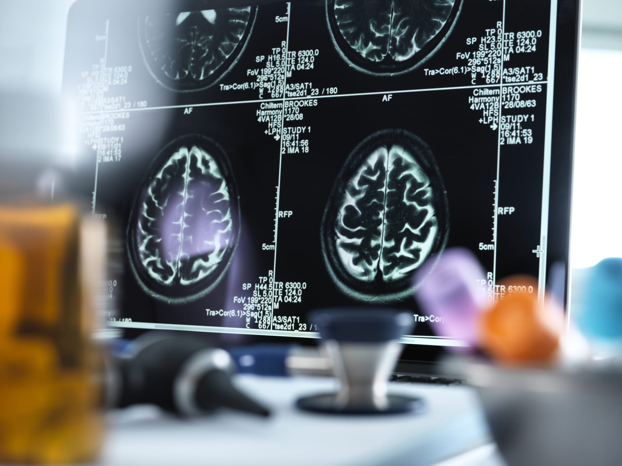 Magnetic resonance imaging (MRI) brain scans displayed on a screen on a doctors desk.